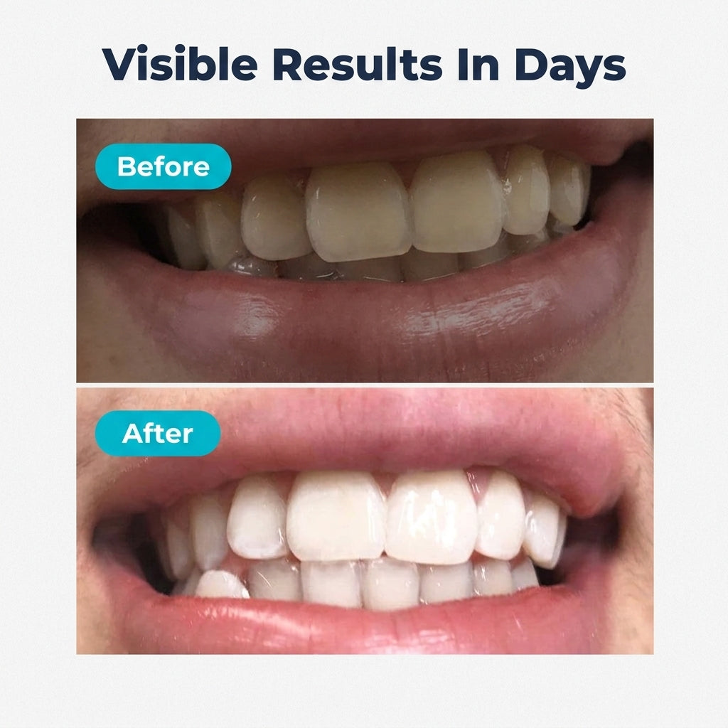 LED Teeth Whitening Kit — Brighter Smile Without Dentist Appointments