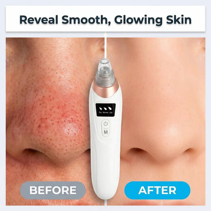 Blackhead Remover Vacuum - Clear Pores Without Harsh Treatments